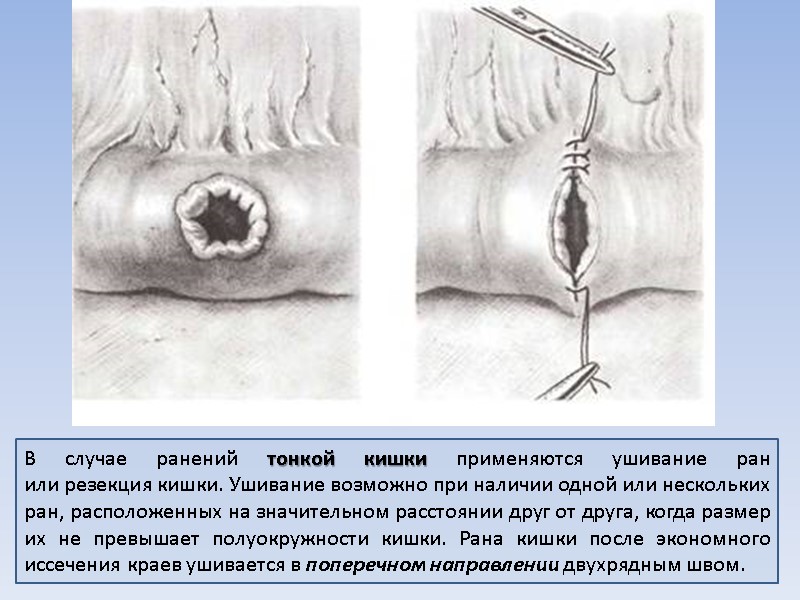 В случае ранений тонкой кишки применяются ушивание ран или резекция кишки. Ушивание возможно при